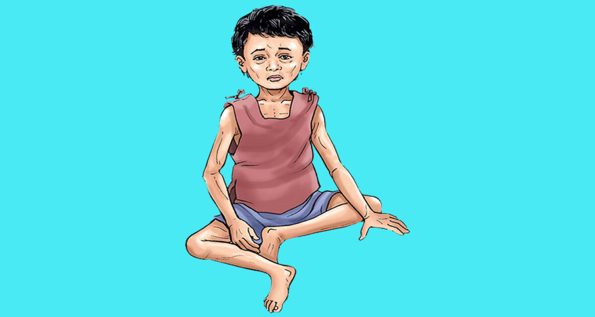 नेपालका बालबालिकालाई तीन वर्षभित्र कुपोषणमुक्त गर्ने अभियान सुरु